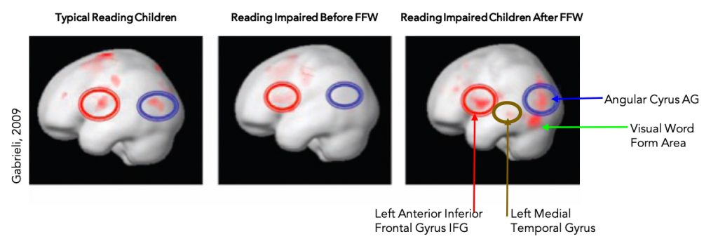 Brain scans before and after Fast ForWord training